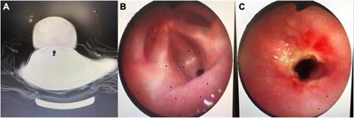 Case Report: A Rare Cause of Stridor and Hoarseness in Infants—Congenital Laryngeal Web